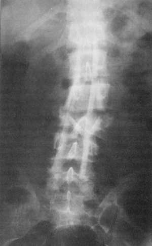 Рис. 12.7. Рентгенограмма после хирургического вмешательства при повреждении L3-позвонка (прямая проекция)