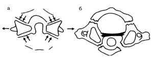 Рис. 1.4. Схема Джефферсона (1960), иллюстрирующая механизм возникновения растрескивающегося перелома