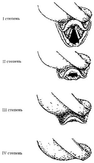 Рис. 2.2. Классификация Malampatti
