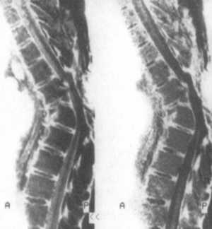 Рис. 12.1. МРТ-исследование грудного отдела