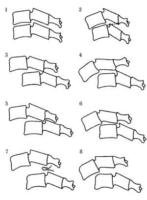 Рис. 1.1. Схематическое изображение различных вывихов позвонков