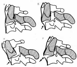 Рис. 1.10. Варианты смещений при переломах ножек дуги аксиса