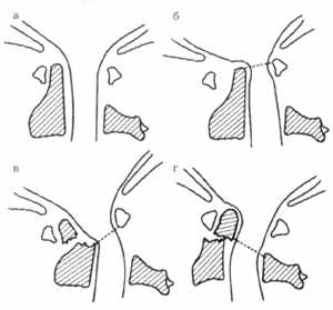Рис. 1.2. Схематическое изображение атланто-аксиальных вывихов