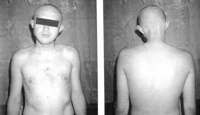 Рис. 1.3. Правосторонний ротационный подвывих атланта