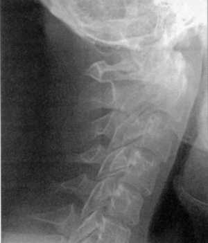 Рис 1.7. Ротационный вывих атланта по данным цифровой спондилографии