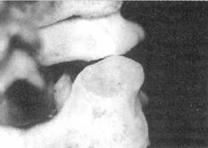 Рис. 2.12.11. Наклон головы влево. Правый сустав. Вид сзади