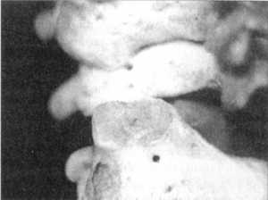 Рис. 2.12.12. Наклон головы влево, Левый сустав. Вид сзади