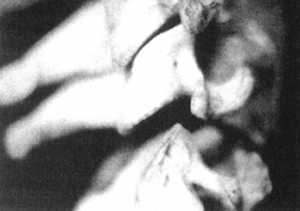 Рис. 2.12.13. Ротация головы вправо. Правый сустав. Вид сбоку 