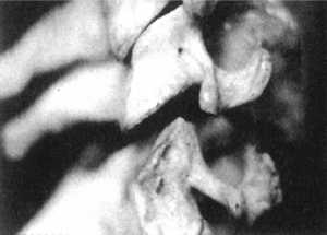 Рис 2.12.14. Установка головы в физиологическое положение. Правый сустав. Вид сбоку