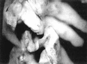 Рис. 2.12.15. Установка головы в физиологическое положение. Левый сустав. Вид сбоку