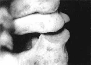 Рис. 2.12.16. Установка головы в физиологическое положение. Правый сустав. Вид сзади