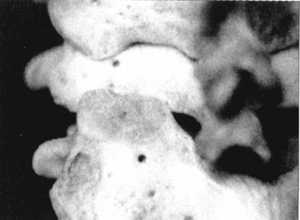 Рис. 2.12.17. Установка головы в физиологическое положение. Левый сустав. Вид сзади