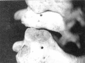 Рис. 2.12.19. Наклон головы. Левый сустав. Вид сзади