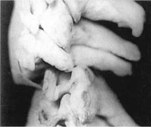 Рис. 2.12.2. Вывих. Левый сустав. Вид сбоку 