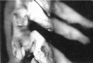 Рис. 2.12.20. Ротация головы влево. Левый сустав. Вид сбоку