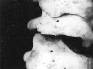 Рис. 2.12.21. Ротация головы влево. Левый сустав. Вид сзади