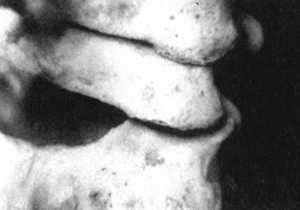 Рис. 2.12.22. Ротация головы влево Правый сустав. Вид сзади