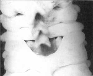 Рис. 2.12.3. Вывих. Правый сустав. Вид сзади