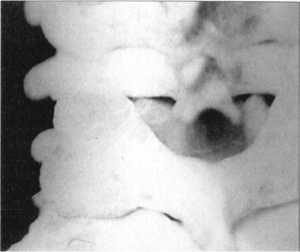 Рис. 2.12.4. Вывих. Левый сустав. Вид сзади