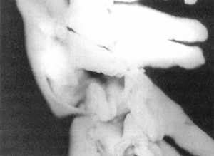 Рис. 2.12.6. Вытяжение. Левый сустав. Вид сбоку