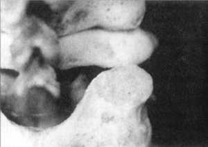 Рис. 2.12.7. Вытяжение. Правый сустав. Вид сзади