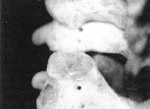 Рис. 2.12.8. Вытяжение. Левый сустав. Вид сзади