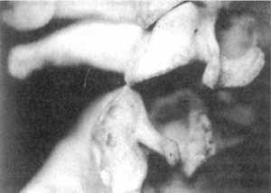 Рис. 2.12.9. Наклон головы влево. Правый сустав. Вид сбоку