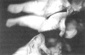 Рис. 2.15.1. Вытяжение с наклоном головы вперед. Правый сустав. Вид сбоку