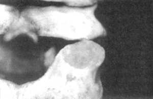 Рис. 2.15.3. Вытяжение с наклоном головы вперед. Правый сустав. Вид сзади