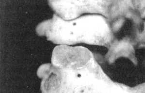 Рис. 2.15.4. Вытяжение с наклоном головы вперед. Левый сустав. Вид сзади