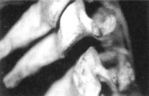 Рис. 2.15.5. Установка головы в физиологическое положение. Правый сустав. Вид сбоку