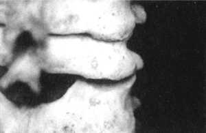 Рис. 2.15.7. Установка головы в физиологическое положение. Правый сустав. Вид сзади