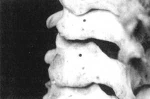 Рис. 2.15.8. Установка головы в физиологическое положение. Левый сустав. Вид сзади