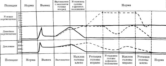Рис. 2.17. Сравнительная характеристика одномоментных закрытых вправлений двустороннего сцепившегося вывиха по методу Рише-Гютера и предлагаемым способом