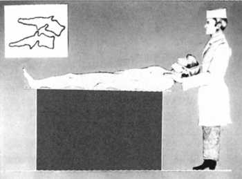 Рис. 2.19.2. Сила вытяжения максимальна, ноги хирурга прямые, голова больного наклонена вперед