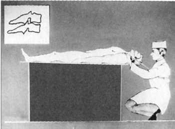 Рис. 2.19.4. Хирург приседает глубже первоначального своего положения, голова больного запрокинута назад, сила вытяжения минимальна