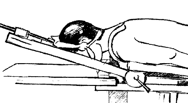 Рис. 2.21. Положение больного перед началом вправления вывиха. Сила вытяжения минимальна и направлена вдоль оси позвоночника. Голова фиксирована кольцом из марлевых рамок