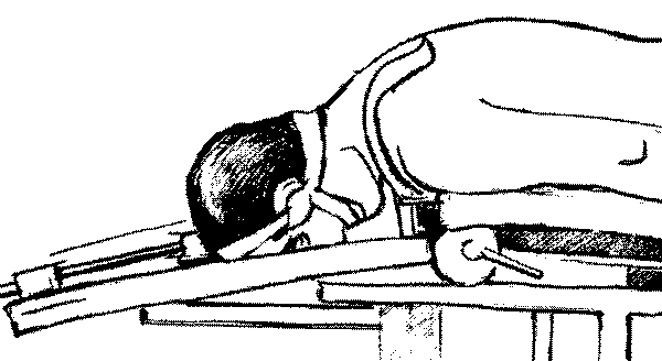 Рис. 2.22. Шейный отдел позвоночника больного в положении сгибания. Сила вытяжения максимальна