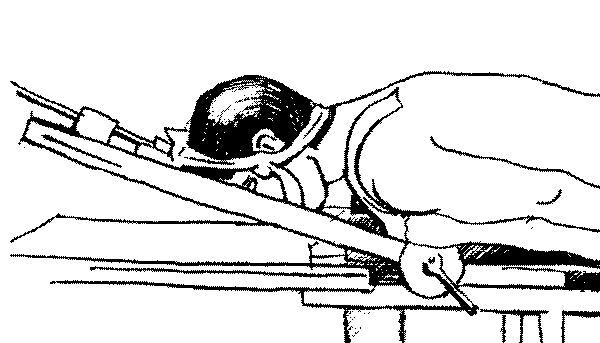 Рис. 2.23. Шейный отдел позвоночника больного розогнут до первоначального положения. Сила вытяжения продолжает оставаться максимальной