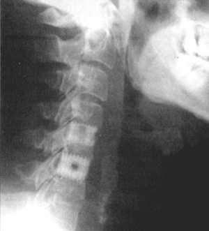 Рис. 3.3. Межтеловой остеосинтез сапфировыми шайбами