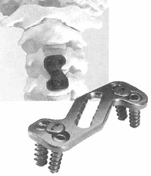 Рис. 3.8. Пластины для переднего спондилодеза